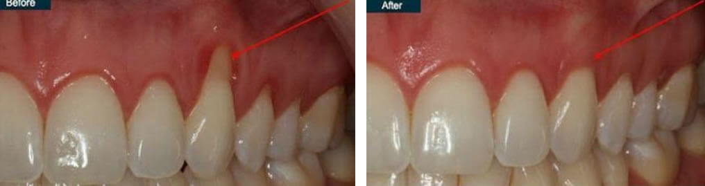 Gingival Recession Coverage