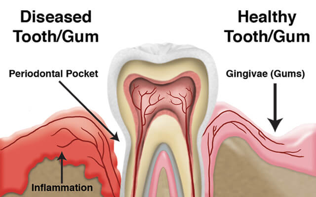 Gum Treatment in Ahmedabad