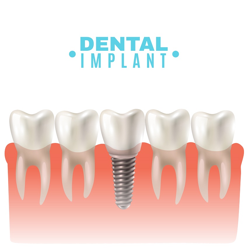 Dental Implants