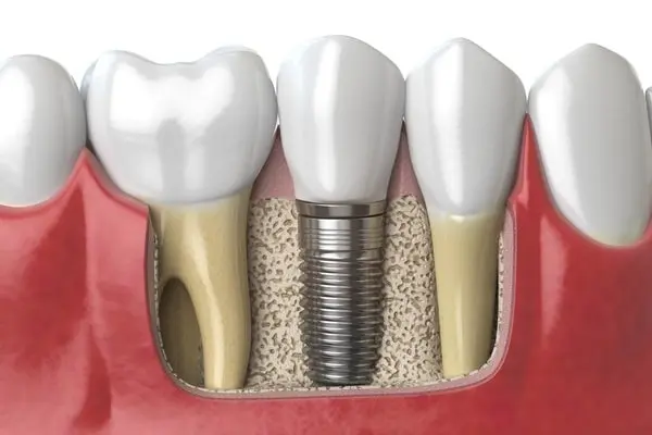 Dental Implants cost in india