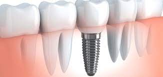 benefits dental implants