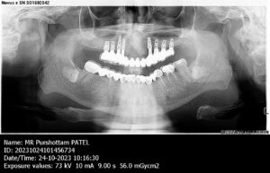 dental implants