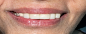 after veneers