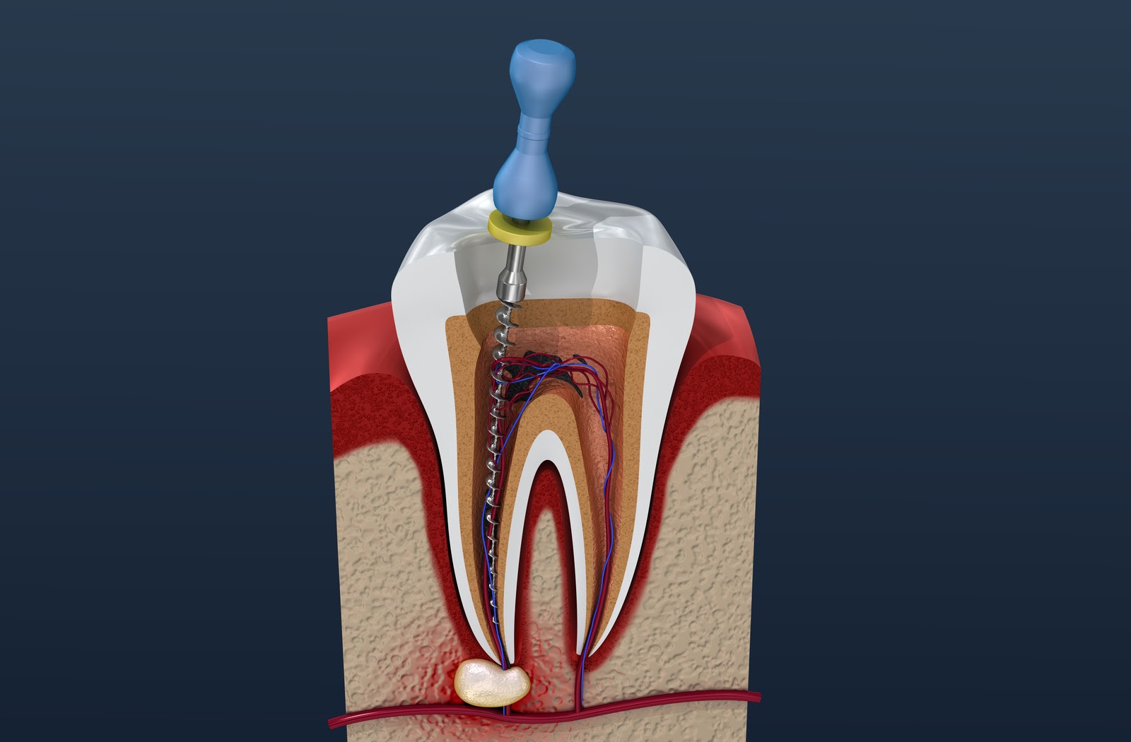 root canal treatment