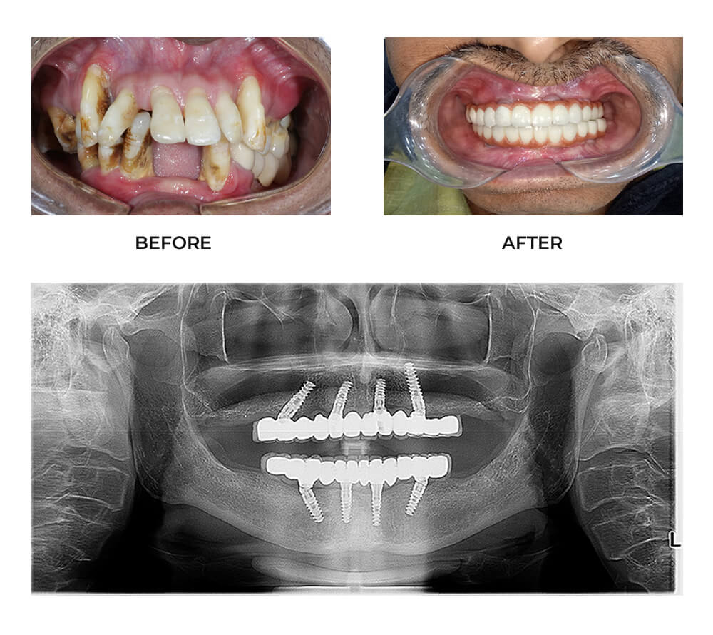 All on 4 dental implants in Ahmedabad