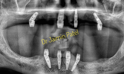Smile Treatment