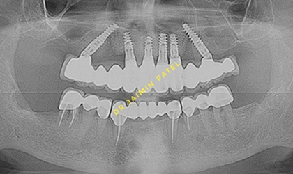 Smile Treatment