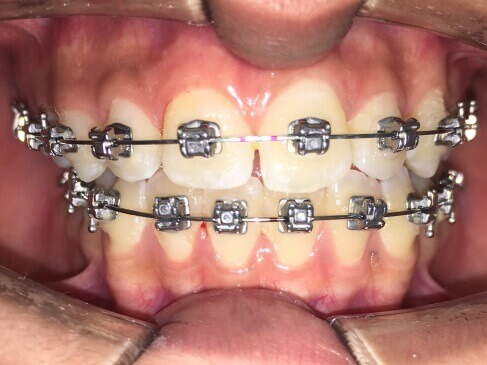 Braces Treatment Image