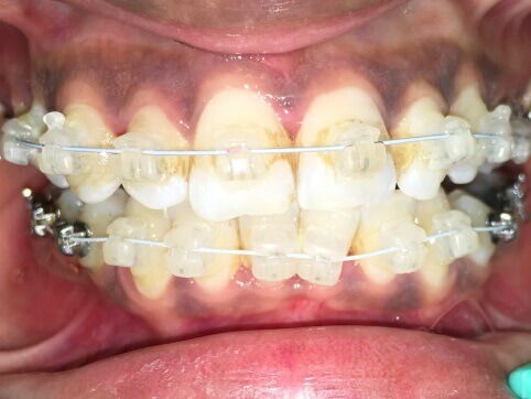 Braces Treatment Image