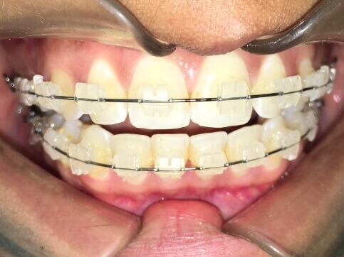 Braces Treatment Image