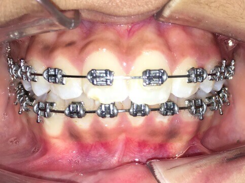 Braces Treatment Image