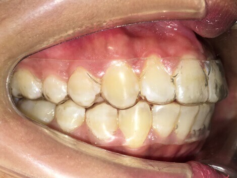 Braces Treatment Image