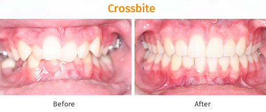 Braces Treatment Image