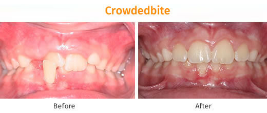 Braces Treatment Image