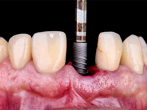 Dental Implant Cost