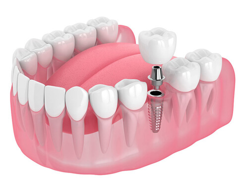 Best Dental Implant