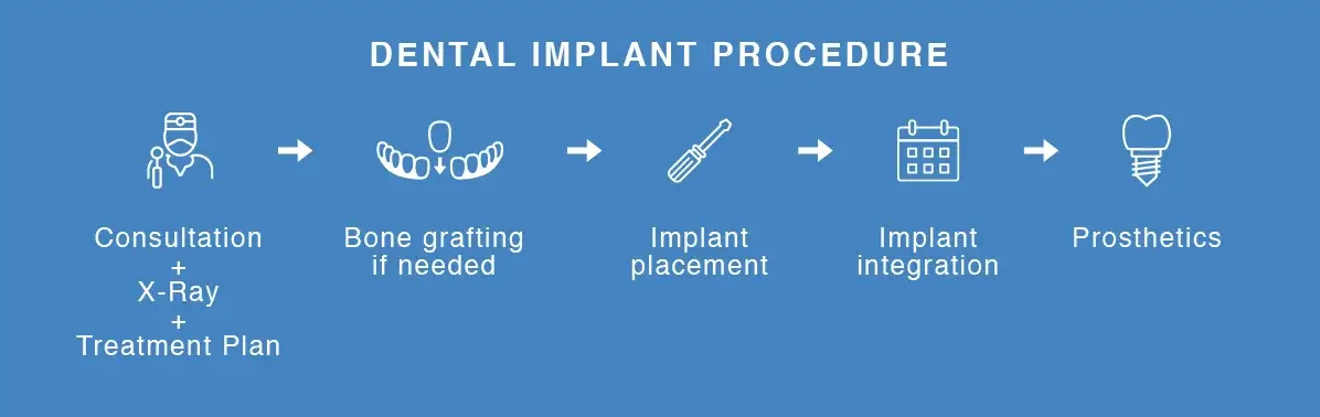 Dental Implnt Procedure