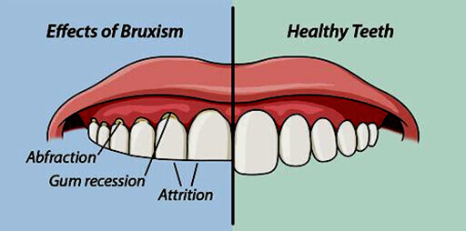 full mouth rehabilitation