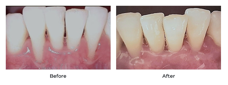 Gum care