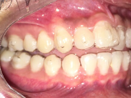 Braces Treatment Image