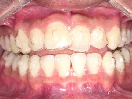 Braces Treatment Image