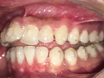 Braces Treatment Image