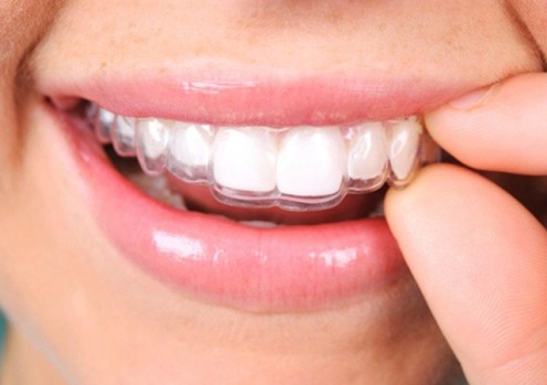 Braces Treatment Image