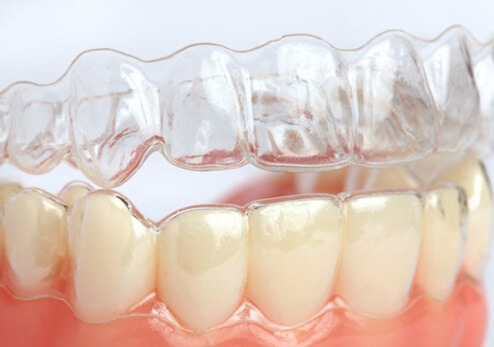 Braces Treatment Image