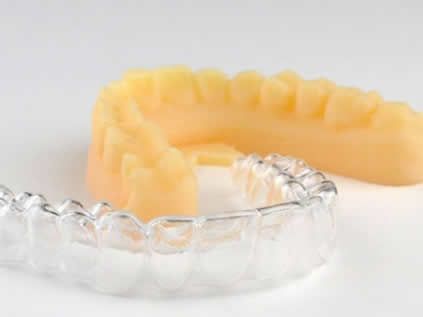 aligners Treatment Image