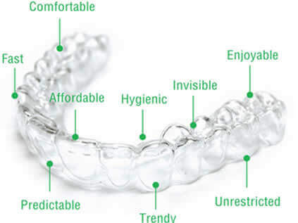 aligners Treatment Image