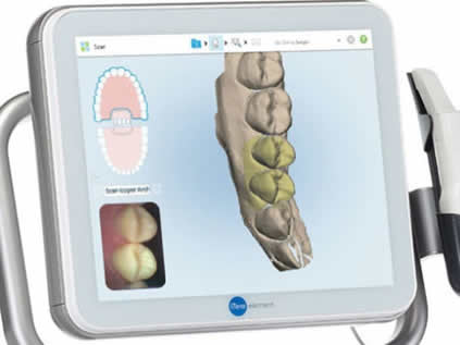 Braces Treatment Image