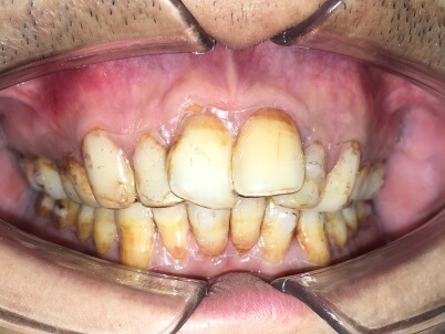Braces Treatment Image