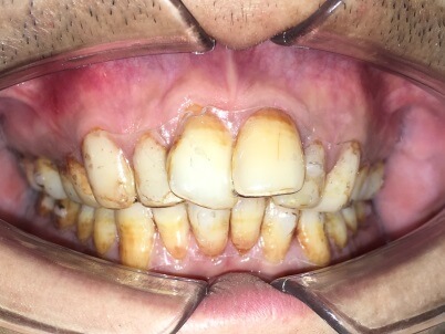 Braces Treatment Image