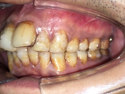 Braces Treatment Image