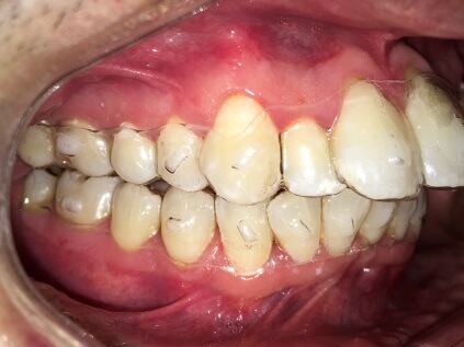 Braces Treatment Image