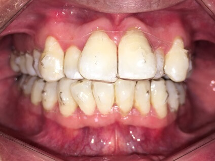 Braces Treatment Image