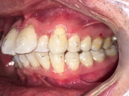 Braces Treatment Image