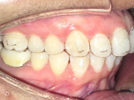 Braces Treatment Image