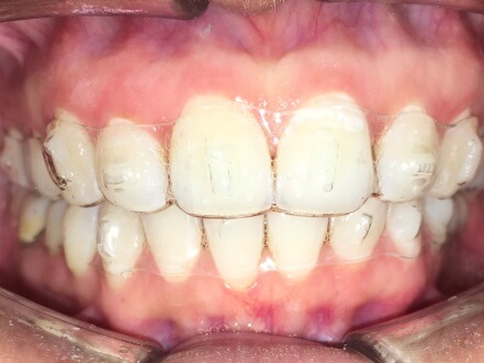 Braces Treatment Image