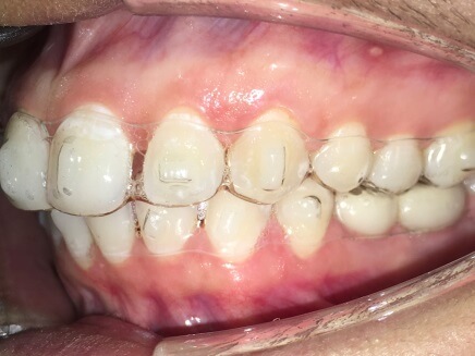 Braces Treatment Image