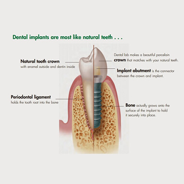 Dental Implant