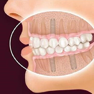 Dental Implant