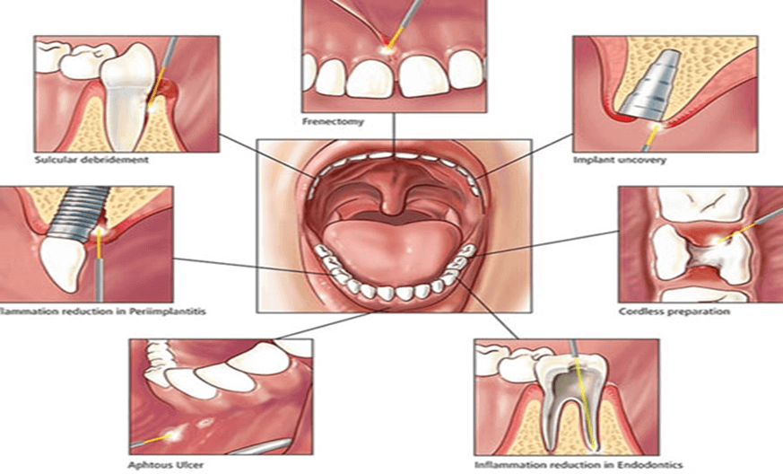 Laser Dentistry in Ahmedabad