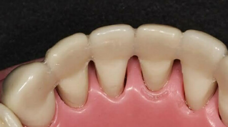 Occlusal Adjustment and Splinting