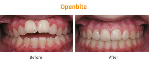 Braces Treatment Image