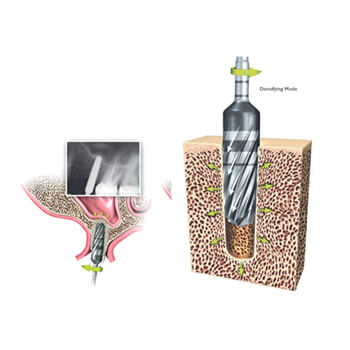 Osseodensification