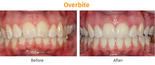 Braces Treatment Image