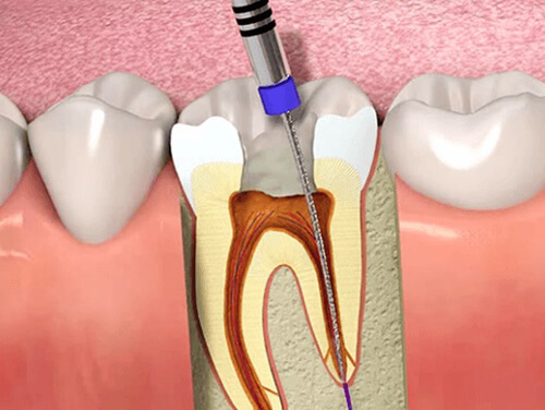 Root Canal Treatment in India