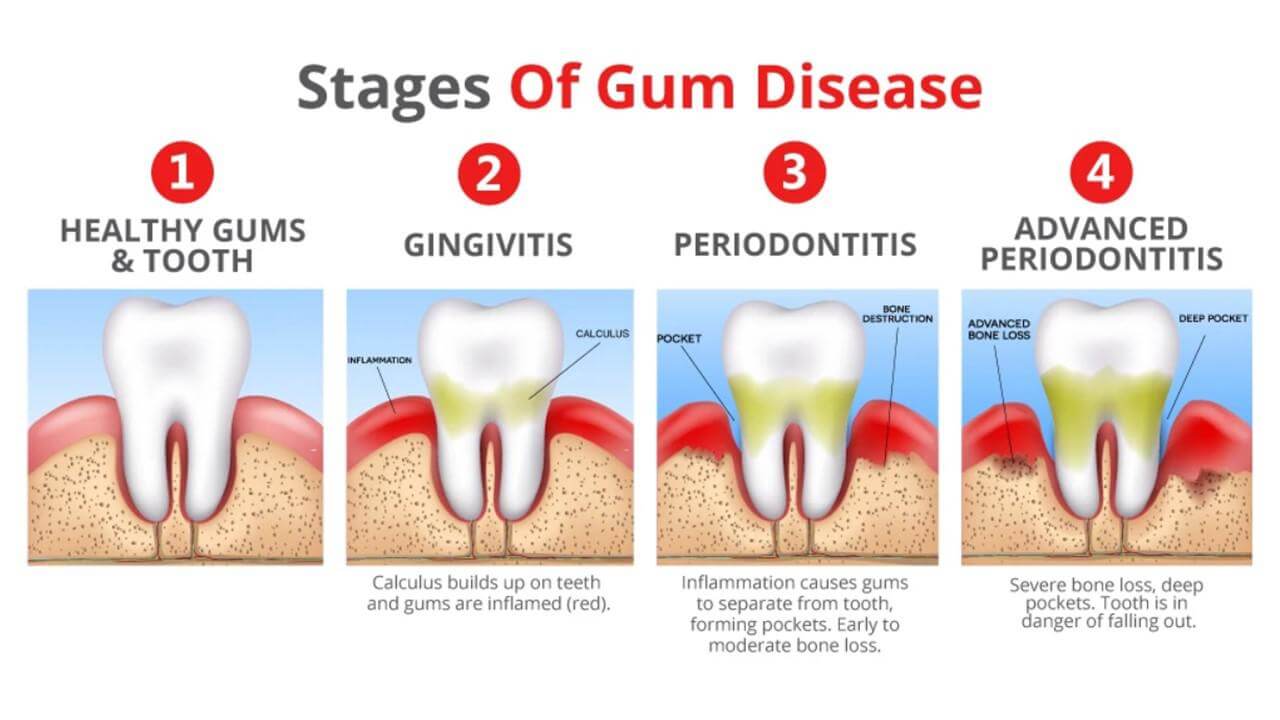 Pyorrhea or Gum disease