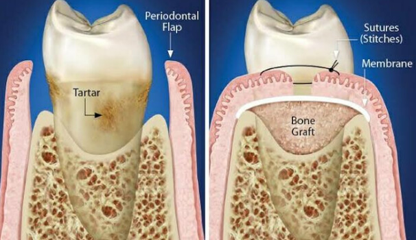 Surgical Treatment